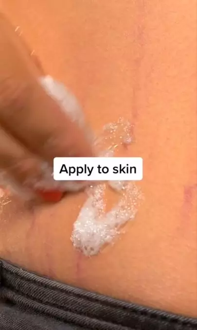 Samarkan stretch mark dengan 1 jenis sumber protein Berbagai sumber Samarkan stretch mark dengan 1 jenis sumber protein Berbagai sumber