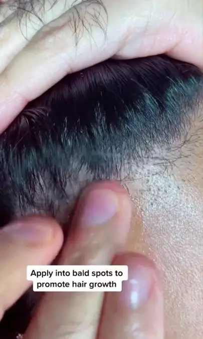 Atasi kebotakan akibat rontok pakai 2 jenis minyak Berbagai sumber