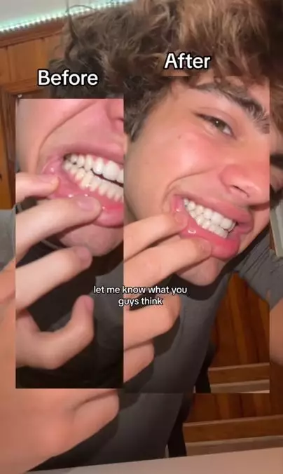 Hilangkan noda kuning pada gigi pakai 1 jenis minyak Berbagai sumber Hilangkan noda kuning pada gigi pakai 1 jenis minyak Berbagai sumber