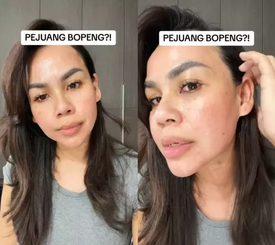 Melaney Ricardo wajah bopeng © TikTok