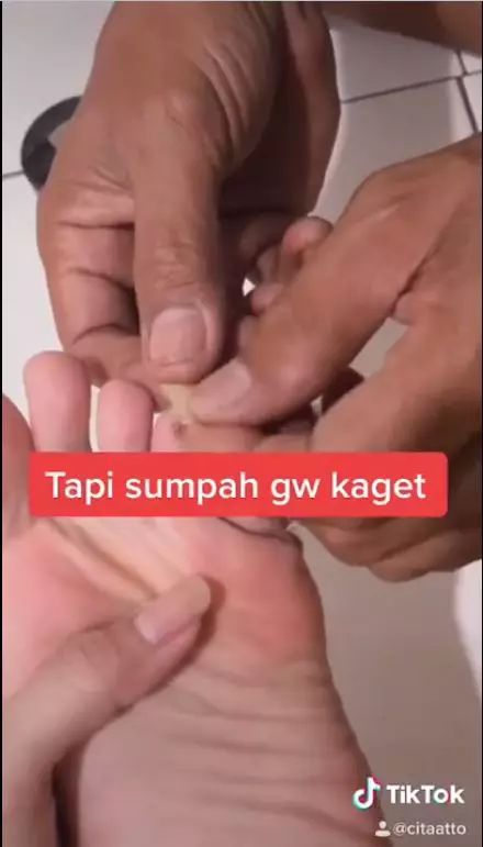 hilangkan mata ikan  berbagai sumber hilangkan mata ikan  berbagai sumber