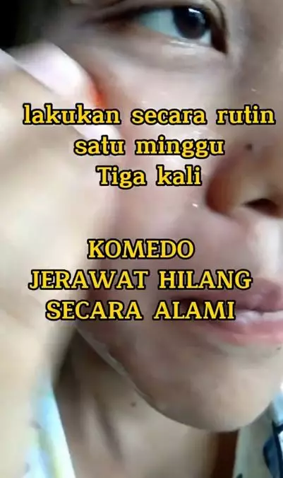 Hilangkan komedo dan jerawat pakai 1 jenis buah-buahan Berbagai sumber