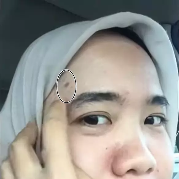 Trik mengatasi kulit wajah yang terciprat minyak panas © YouTube