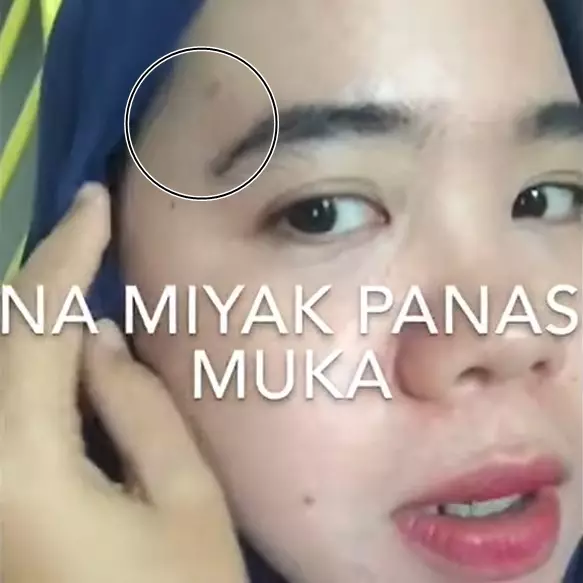 Trik mengatasi kulit wajah yang terciprat minyak panas © YouTube