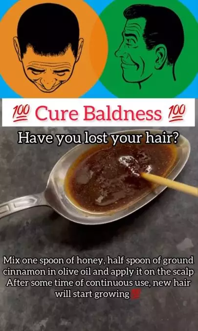 Tumbuhkan rambut botak pria dengan tambahan 1 rempah Berbagai sumber