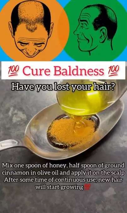 Tumbuhkan rambut botak pria dengan tambahan 1 rempah Berbagai sumber