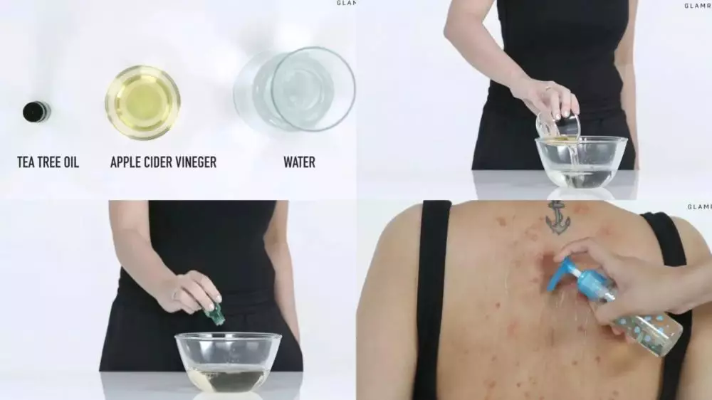 jerawat di punggung © Instagram jerawat di punggung © Instagram