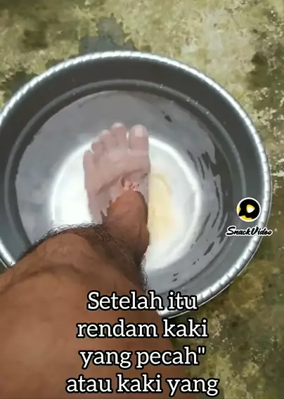 atasi kaki retak pakai madu berbagai sumber