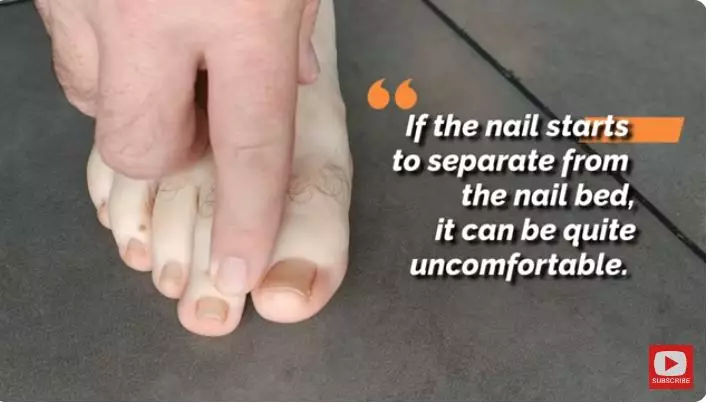 atasi jamur di kuku kaki berbagai sumber atasi jamur di kuku kaki berbagai sumber