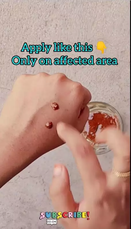 trik mengempeskan jerawat meradang berbagai sumber