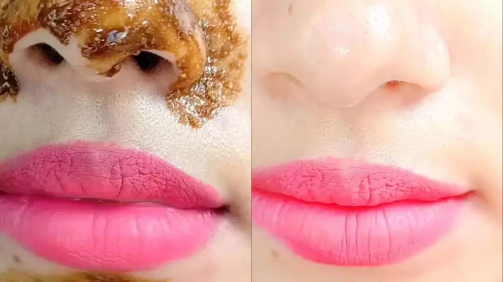 Wajah mulus bebas komedo © Instagram Wajah mulus bebas komedo © Instagram