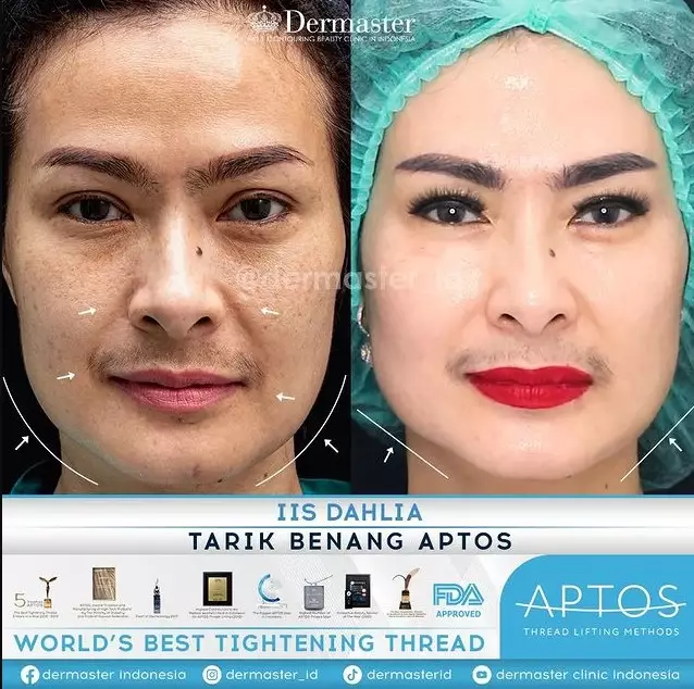 Iis Dahlia perawatan tanam benang © Instagram Iis Dahlia perawatan tanam benang © Instagram