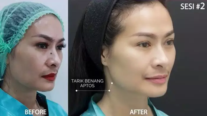Iis Dahlia perawatan tanam benang © Instagram Iis Dahlia perawatan tanam benang © Instagram