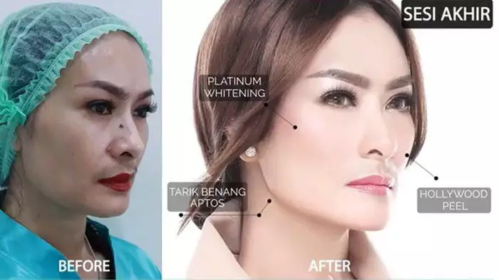 Iis Dahlia perawatan tanam benang © Instagram Iis Dahlia perawatan tanam benang © Instagram