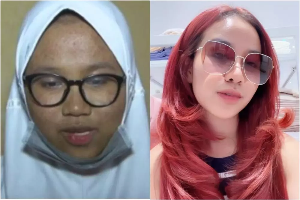 mayang sebelum dan sesudah operasi © berbagai sumber