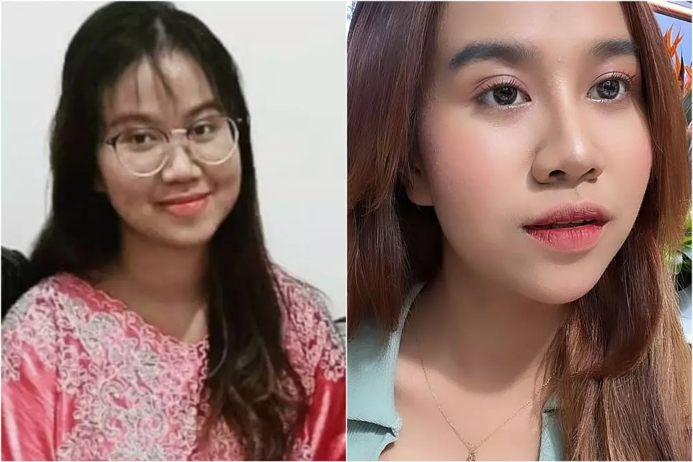 mayang sebelum dan sesudah operasi © berbagai sumber