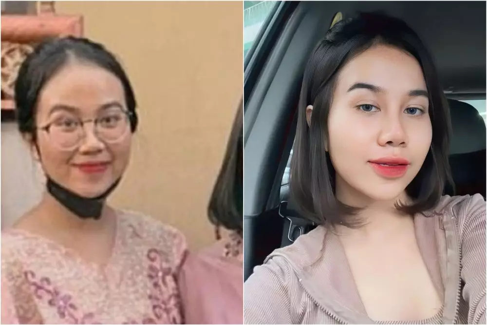 mayang sebelum dan sesudah operasi © berbagai sumber