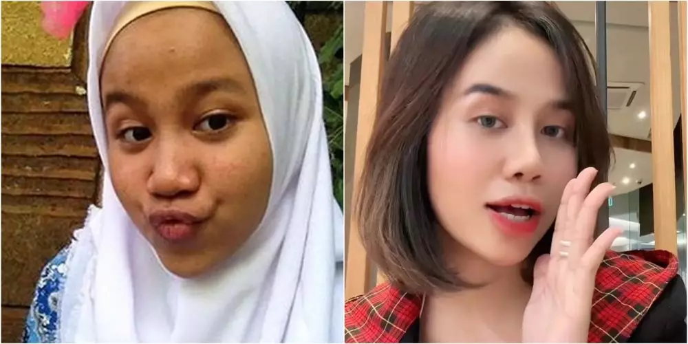 mayang sebelum dan sesudah operasi © berbagai sumber