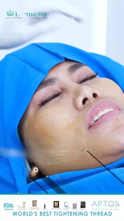 Evi Masamba usai perawatan tanam benang © berbagai sumber