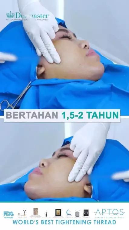 Evi Masamba usai perawatan tanam benang © berbagai sumber