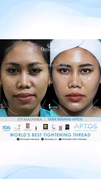 Evi Masamba usai perawatan tanam benang © berbagai sumber