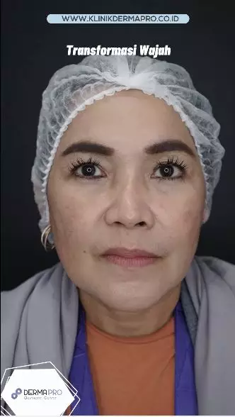 transformasi wajah umi kalsum © instagram transformasi wajah umi kalsum © instagram