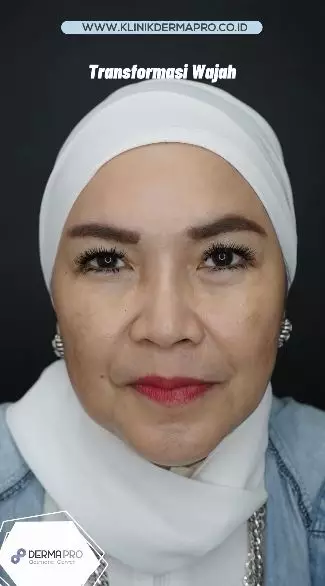 transformasi wajah umi kalsum © instagram transformasi wajah umi kalsum © instagram