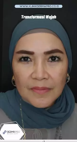 transformasi wajah umi kalsum © instagram transformasi wajah umi kalsum © instagram