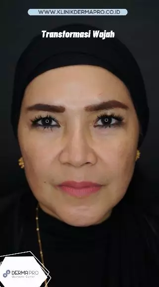 transformasi wajah umi kalsum © instagram transformasi wajah umi kalsum © instagram