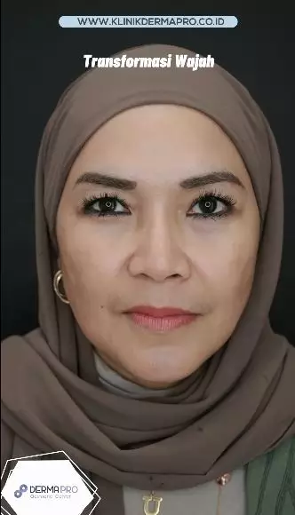 transformasi wajah umi kalsum © instagram transformasi wajah umi kalsum © instagram