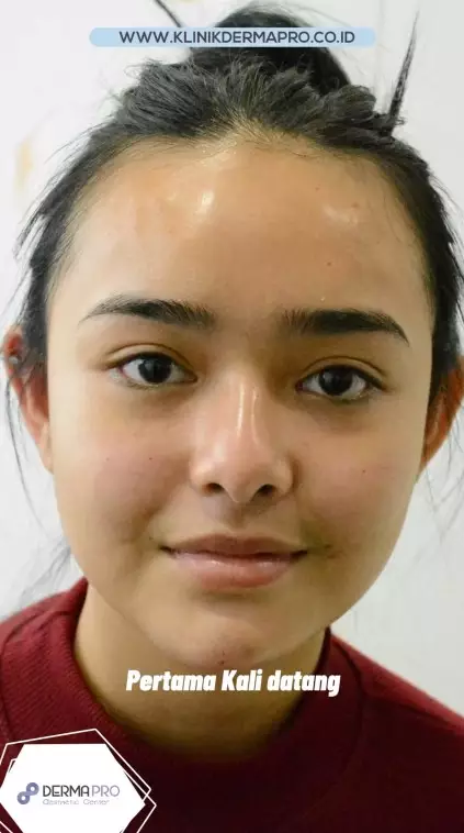 Amanda Manopo sebelum dan sesudah perawatan © berbagai sumber