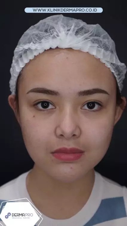 Amanda Manopo sebelum dan sesudah perawatan © berbagai sumber