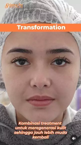 Amanda Manopo sebelum dan sesudah perawatan © berbagai sumber