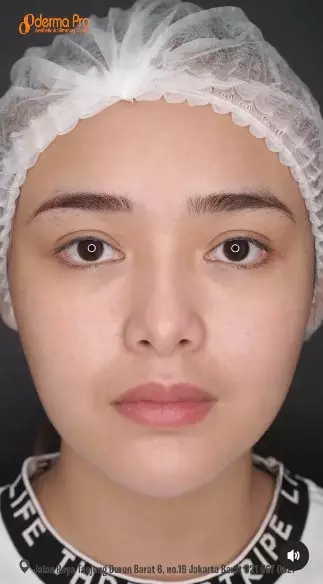 Amanda Manopo sebelum dan sesudah perawatan © berbagai sumber