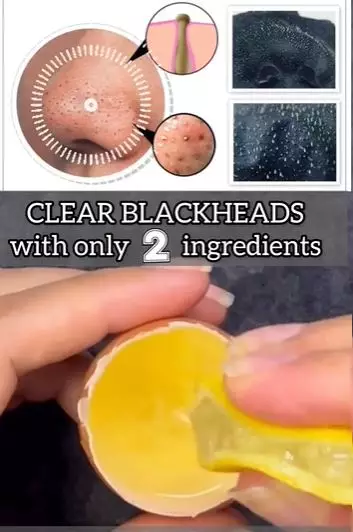 Hilangkan komedo hitam di area hidung Berbagai sumber