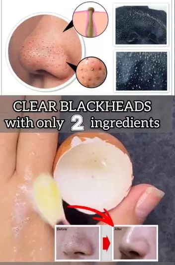 Hilangkan komedo hitam di area hidung Berbagai sumber