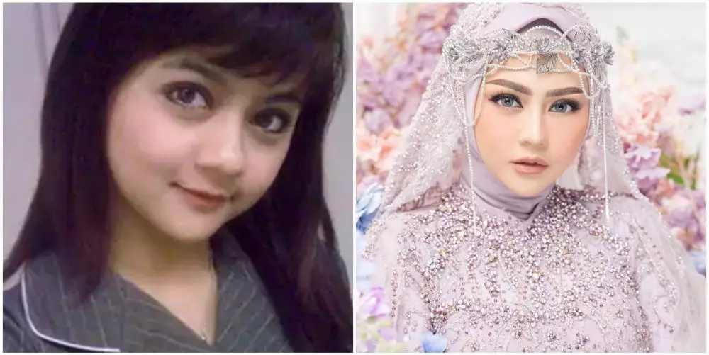 potret pedangdut sebelum dan sesudah tanam benang © berbagai sumber potret pedangdut sebelum dan sesudah tanam benang © berbagai sumber