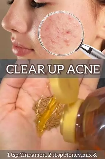 Pudarkan jerawat dan bekasnya Berbagai sumber