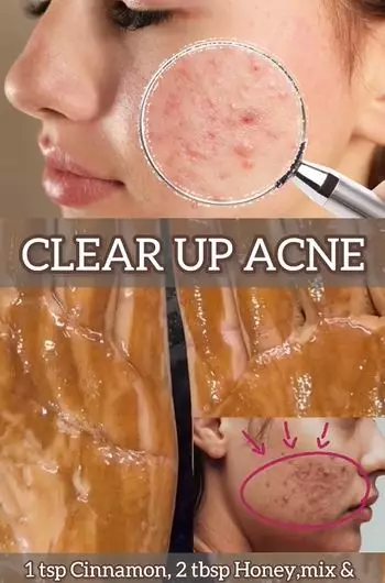 Pudarkan jerawat dan bekasnya Berbagai sumber