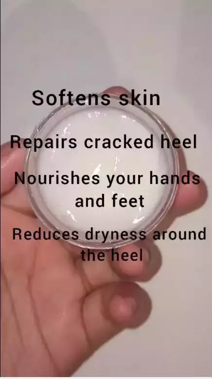  tumit kering penuh retak © YouTube