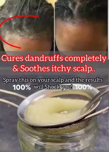 Atasi kepala berminyak pakai 1 jenis bumbu dapur Berbagai sumber Atasi kepala berminyak pakai 1 jenis bumbu dapur Berbagai sumber