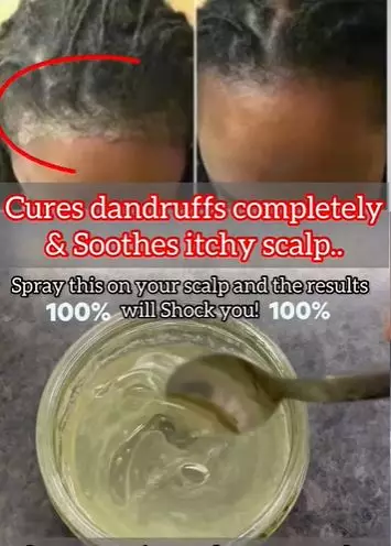 Atasi kepala berminyak pakai 1 jenis bumbu dapur Berbagai sumber Atasi kepala berminyak pakai 1 jenis bumbu dapur Berbagai sumber