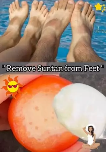 Atasi kaki belang akibat sinar matahari Berbagai sumber Atasi kaki belang akibat sinar matahari Berbagai sumber