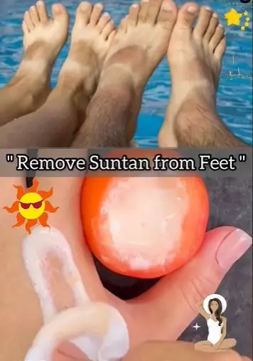 Atasi kaki belang akibat sinar matahari Berbagai sumber Atasi kaki belang akibat sinar matahari Berbagai sumber