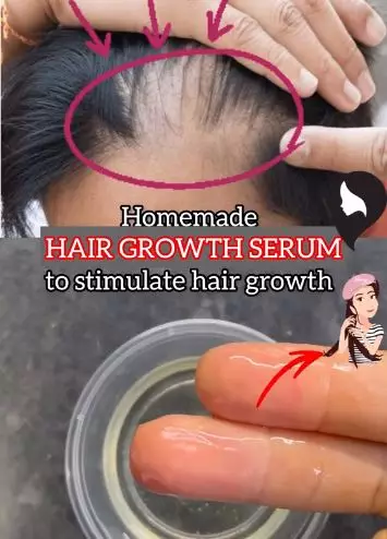 Tumbuhkan rambut pitak area dahi pakai 3 minyak Berbagai sumber