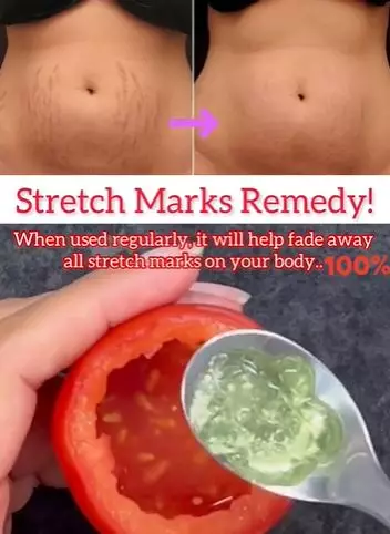 Pudarkan stretch mark pada perut dan paha Berbagai sumber Pudarkan stretch mark pada perut dan paha Berbagai sumber