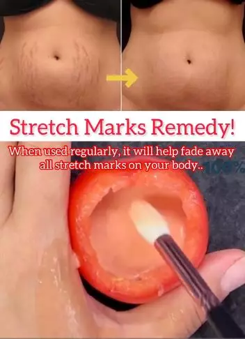 Pudarkan stretch mark pada perut dan paha Berbagai sumber Pudarkan stretch mark pada perut dan paha Berbagai sumber