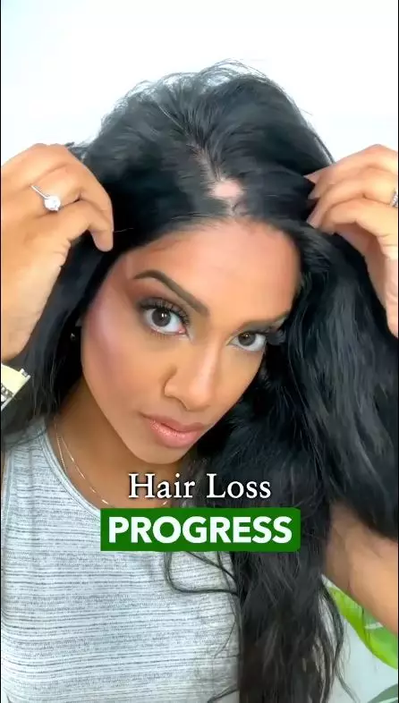 atasi rambut pitak di dahi berbagai sumber