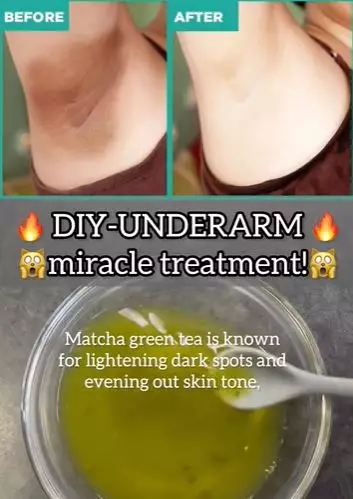 Cerahkan ketiak hitam dan berbau Berbagai sumber