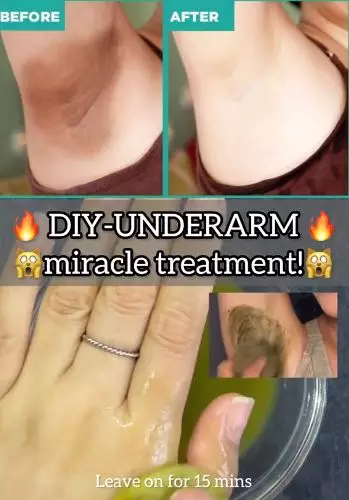 Cerahkan ketiak hitam dan berbau Berbagai sumber